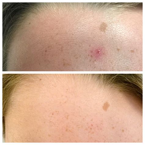 Angioma Removal 498 Medical Spa Houston And Webster Tx M Spa Face