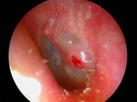 An infection in the bone behind the to make you understand the cause and symptoms of a swollen ear canal, we have inserted images and pictures. Ear Tube Information