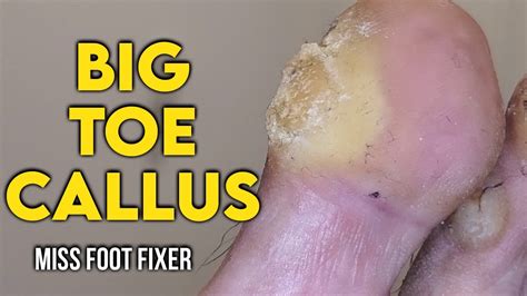 Shaving Of Real Big Toe Callus Biggest Toe Callous Ever Full
