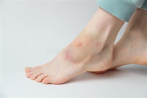 Bruise On The Foot Hematoma After Injury To The Ring Toe Of The Left