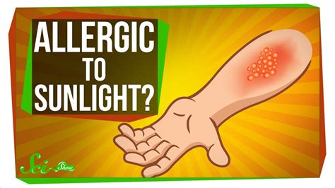 People with some other allergies are more likely to be allergic to cats. Can You Be Allergic To Sunlight? - YouTube