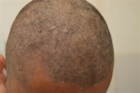 Seborrheic Dermatitis On Scalp About