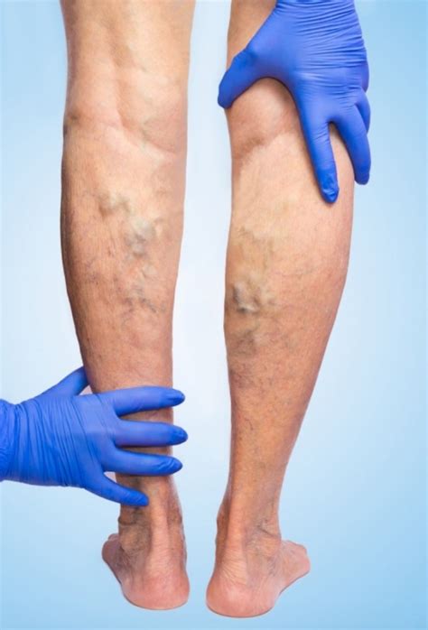 The 7 Myths About Varicose Veins Story Studio