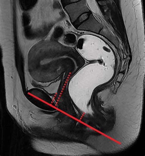 Mr Imagingbased Assessment Of The Female Pelvic Floor Radiographics