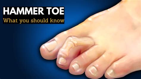 Hammer Toe Or Mallet Toe Causes Signs And Symptoms Diagnosis And