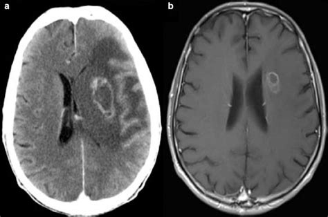 Cerebral Toxoplasmosis Panel A Post Contrast Axial Ct Showing A