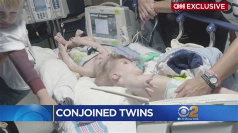 Separating Conjoined Twins Youtube