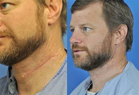 Scar Treatment Before And After Savannah Facial Plastic Surgery