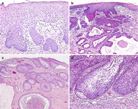 Squamous Cell Carcinoma Of The Cervix Obgyn Key
