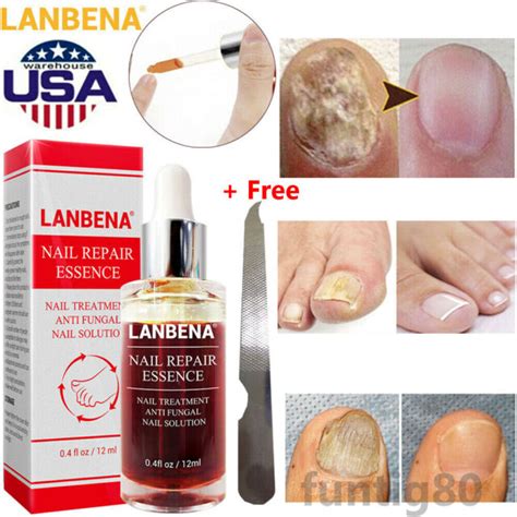 Anti Fungal Nail Treatment Finger Toe Nail Repair Care Fungus Essence