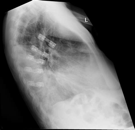 Flail Chest With Subsequent Internal Fixation Of Rib Fractures Image