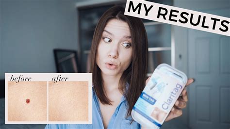 Julia Caban Blog How To Remove Skin Tags In 5 Minutes Does Claritag