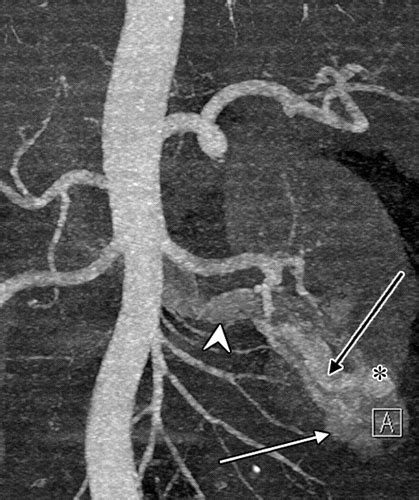 Radiologic Assessment Of Native Renal Vasculature A Multimodality