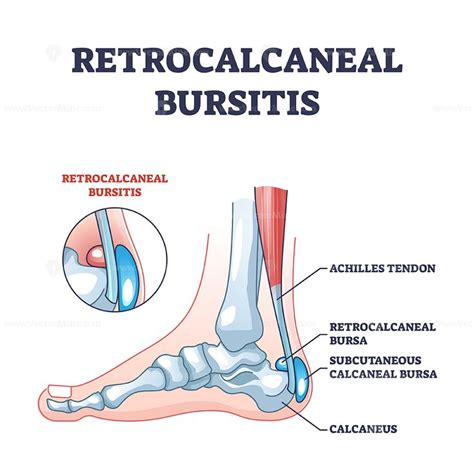 Retrocalcaneal Bursitis As Ankle Or Achilles Tendon Bursa Outline