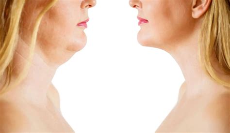 Get Rid Of Loose Skin Under Chin Without Surgery