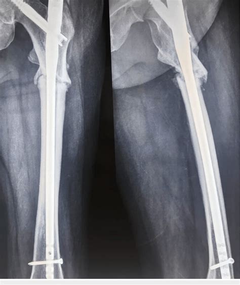One Year Postoperative X Ray Showing Nonunion At The Fracture Site