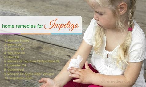 20 Home Remedies For Impetigo Causes Symptoms Prevention