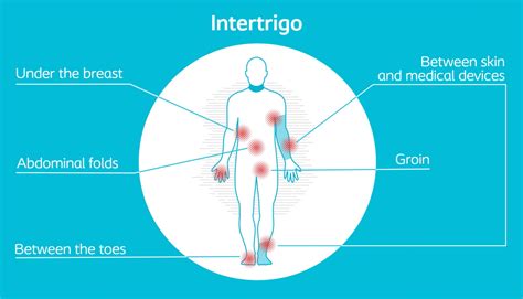 intertrigo treatment at home through coloplast interdry