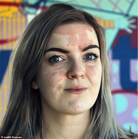 Psoriasis Sufferers Reveal What Its Really Like Living With The Skin Condition Express Digest