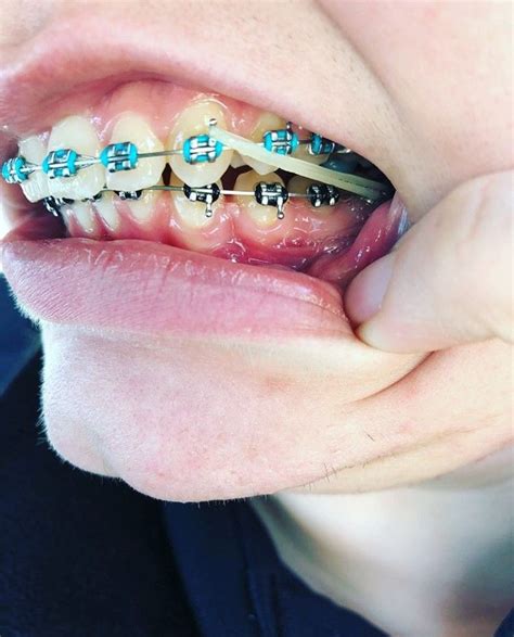 Braces Braceface Metalbraces Girlswithbraces Elastics Adult Braces