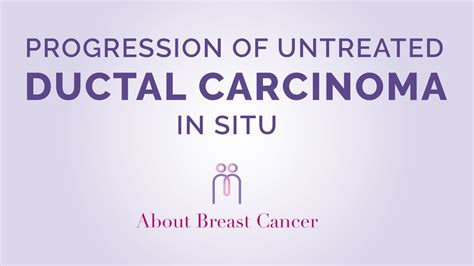 Progression Of Ductal Carcinoma In Situ Youtube