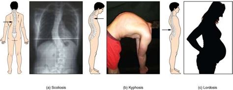 Know The Differences Kyphosis Lordosis And Scoliosis Vivid Care