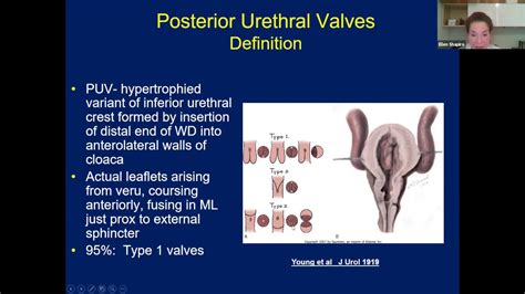 Posterior Urethral Valves Empire Urology Lecture Series Youtube