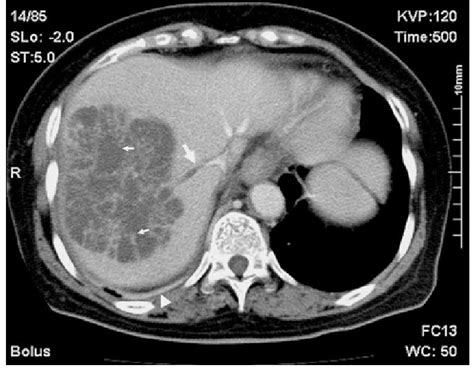 Ct Scan Obtained With Contrast Injection Shows A Large Nonenhancing