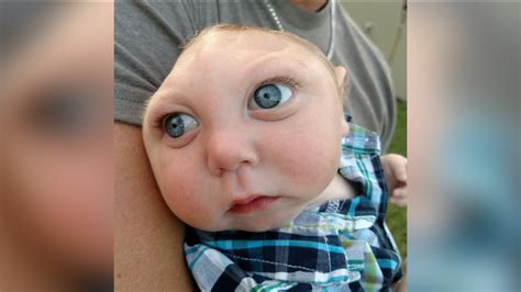 Baby Born Without Part Of Skull Defies Odds Celebrates 1st Birthday