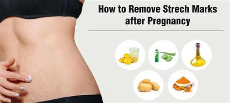 How To Remove Stretch Marks After Pregnancy Pregnancy Medplusmart