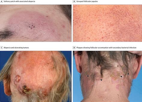 Clinical Staging And Prognostic Factors In Folliculotropic Mycosis