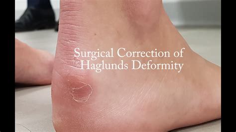 Surgery Haglunds Deformity