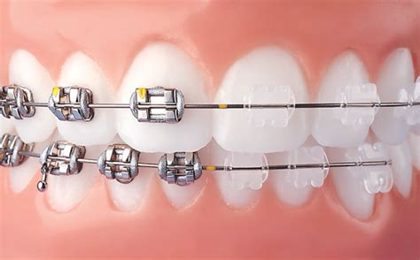 Types Of Braces Braces4u Orthodontic Associates Of Westchester