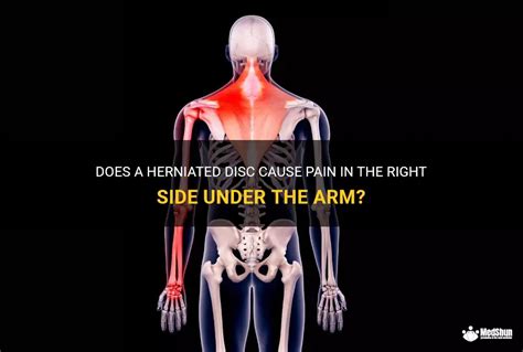 Does A Herniated Disc Cause Pain In The Right Side Under The Arm Medshun
