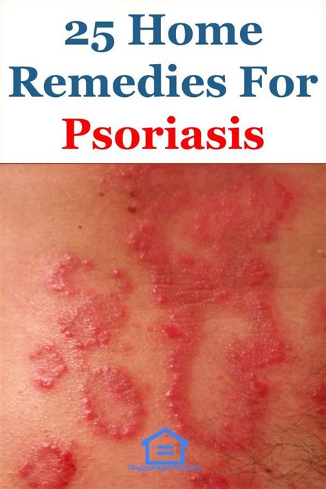 Home Remedies For Psoriasis Home Remedies For Scalp Psoriasis Dry