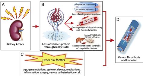 Pathophysiology Of Venous Thromboembolism In Nephrotic