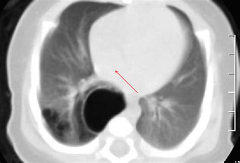Congenital cystic adenomatoid malformation (ccam), also called congenital pulmonary airway malformation (cpam), is a fetal lung lesion that appears before birth as a benign cyst or mass in the. World's Tragic In Medlife,.....You May Know Or Not ...