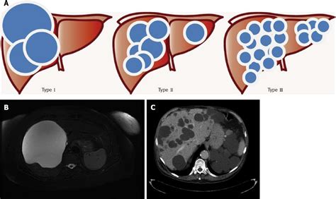 In some cases though, polycystic liver disease can occur with no apparent. Pathophysiology, epidemiology, classification and ...