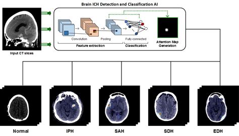 Deep Learning Algorithms Identify Ct Scan Abnormalities In Head Trauma