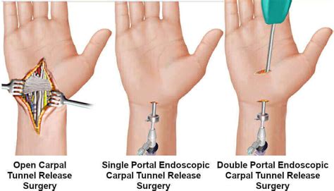 What Happens During Endoscopic Carpal Tunnel Surgery