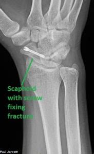 Mr Paul Jarrett Scaphoid Fractures Murdoch Orthopaedic Clinic