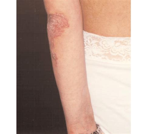 Hyperkeratotic Plaques With Psoriasiform Aspect On The Elbows