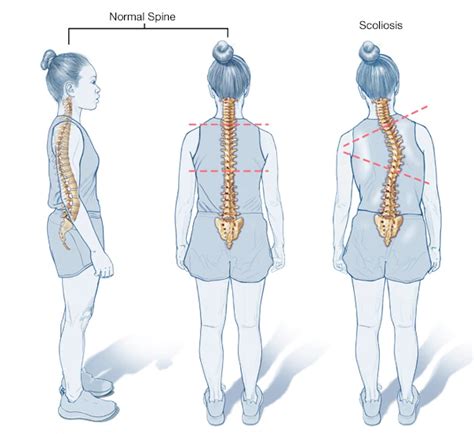 Physiotherapy For Scoliosis In Calgary Bonavista Physio