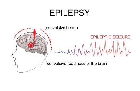 Algorithm Works To Predict An Epileptic Seizure 20 Minutes Before It