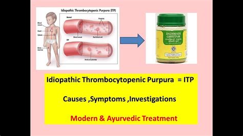 Idiopathic Thrombocytopenic Purpura L Itp L Causes L Symptoms L