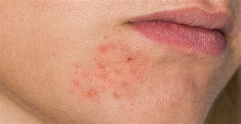 How To Cure Perioral Dermatitis And Do You Have It Truly