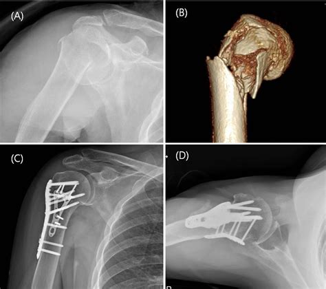 Figure 1 From Technical Tips Dualplate Fixation Technique For