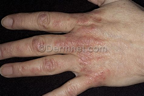 Psoriasis Hand Photo Skin Disease Pictures