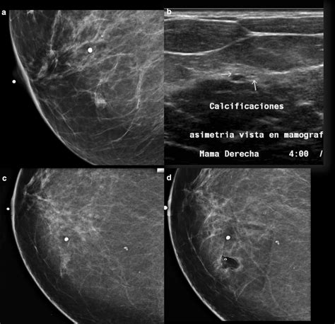 A Mammography Lateral Medial Oblique View Demonstrates A Focal