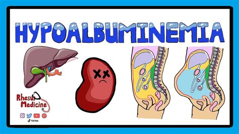 Hypoalbuminemia - Functions of Albumin in the Body + Pathophysiology of